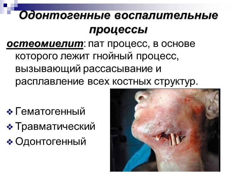 Одонтогенные воспалительные процессы остеомиелит: пат процесс, в основе которого лежит гнойный процесс, вызывающий рассасывание